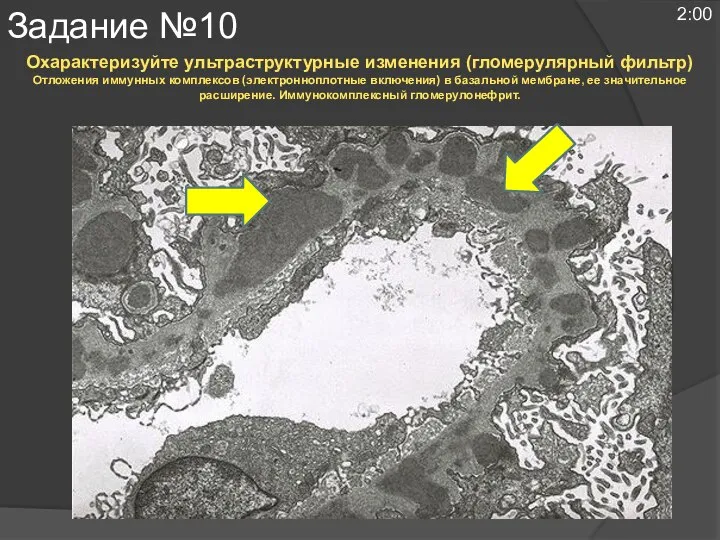 Охарактеризуйте ультраструктурные изменения (гломерулярный фильтр) Отложения иммунных комплексов (электронноплотные включения) в базальной