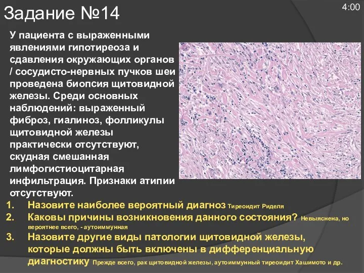 У пациента с выраженными явлениями гипотиреоза и сдавления окружающих органов / сосудисто-нервных