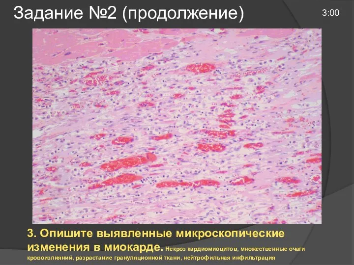 Задание №2 (продолжение) 3:00 3. Опишите выявленные микроскопические изменения в миокарде. Некроз