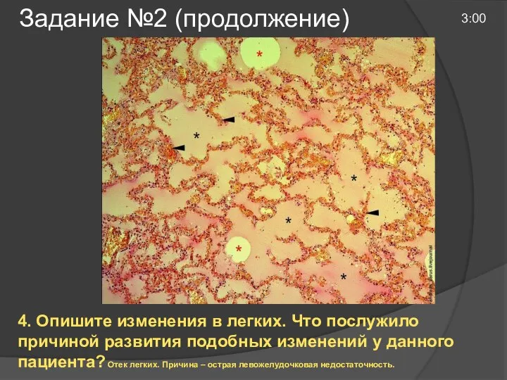 Задание №2 (продолжение) 3:00 4. Опишите изменения в легких. Что послужило причиной