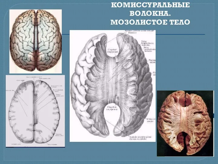 КОМИССУРАЛЬНЫЕ ВОЛОКНА. МОЗОЛИСТОЕ ТЕЛО