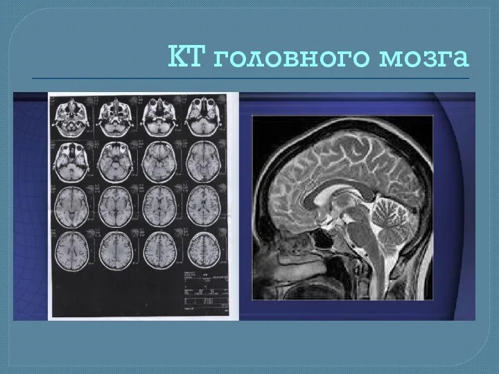 КТ головного мозга