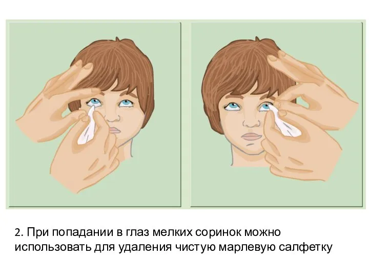 2. При попадании в глаз мелких соринок можно использовать для удаления чистую марлевую салфетку