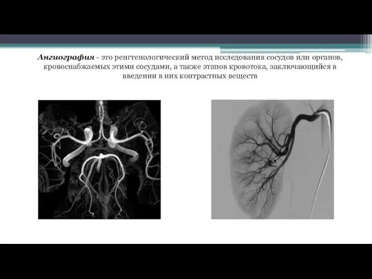 Ангиография - это ренгтенологический метод исследования сосудов или органов, кровоснабжаемых этими сосудами,