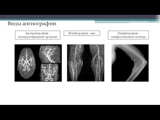 Виды ангиографии Артериография - контрастирование артерий Флебография - вен Лимфография - лимфатической системы