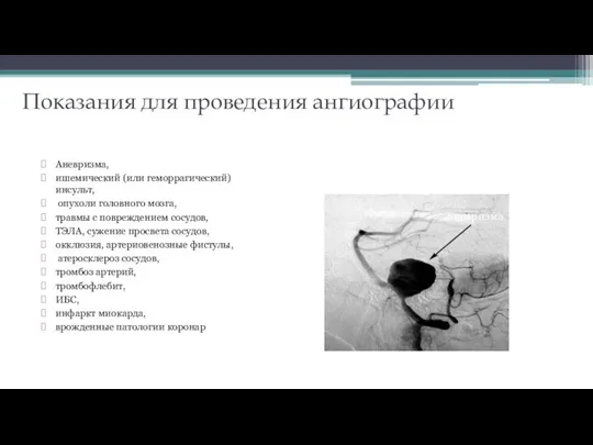 Показания для проведения ангиографии Аневризма, ишемический (или геморрагический) инсульт, опухоли головного мозга,