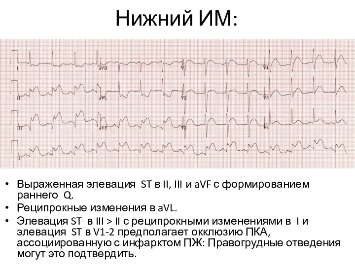 Нижний ИМ: Выраженная элевация ST в II, III и aVF с формированием