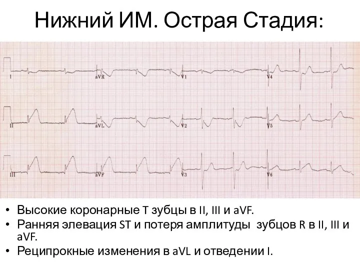 Нижний ИМ. Острая Стадия: Высокие коронарные T зубцы в II, III и