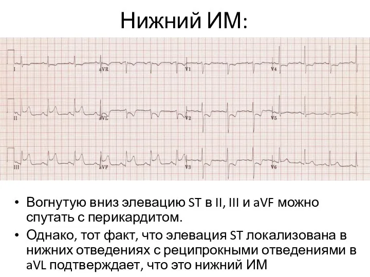 Нижний ИМ: Вогнутую вниз элевацию ST в II, III и aVF можно