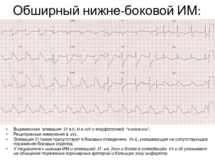 Обширный нижне-боковой ИМ: Выраженная элевация ST в II, III и aVF с