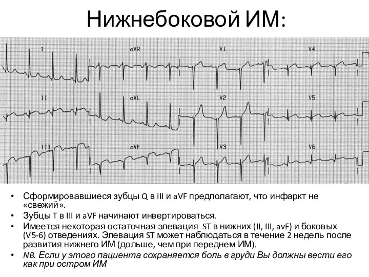 Нижнебоковой ИМ: Сформировавшиеся зубцы Q в III и aVF предполагают, что инфаркт