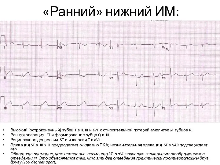 «Ранний» нижний ИМ: Высокий (остроконечный) зубец T в II, III и aVF