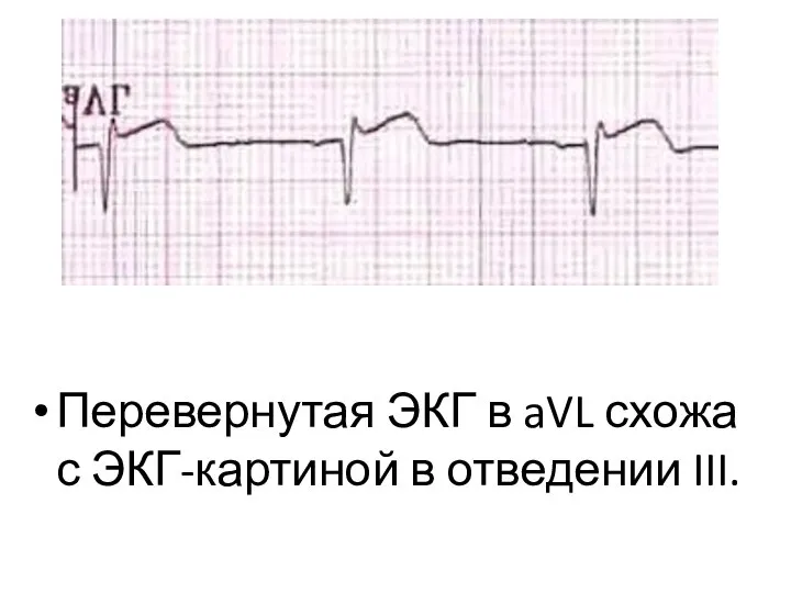 Перевернутая ЭКГ в aVL схожа с ЭКГ-картиной в отведении III.