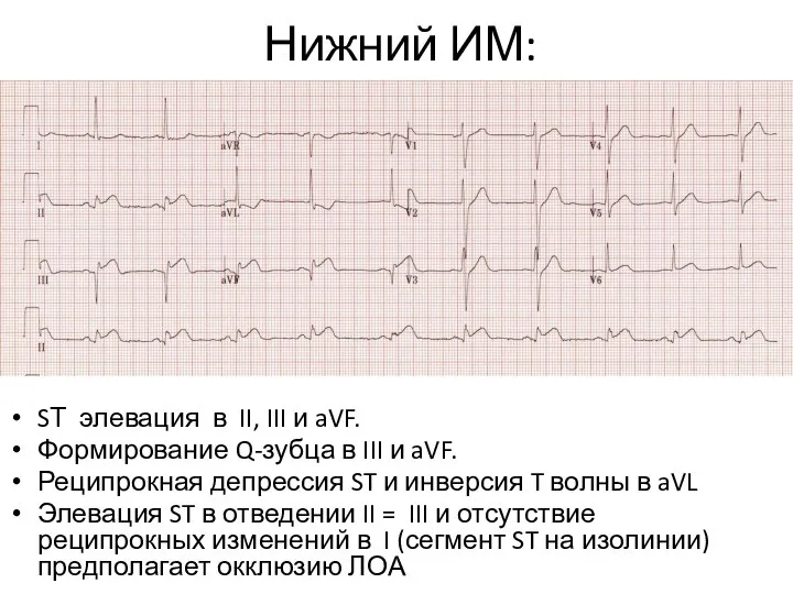 Нижний ИМ: SТ элевация в II, III и aVF. Формирование Q-зубца в