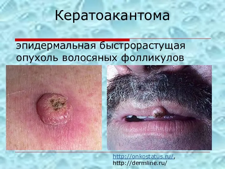 Кератоакантома эпидермальная быстрорастущая опухоль волосяных фолликулов http://onkostatus.ru/, http://dermline.ru/