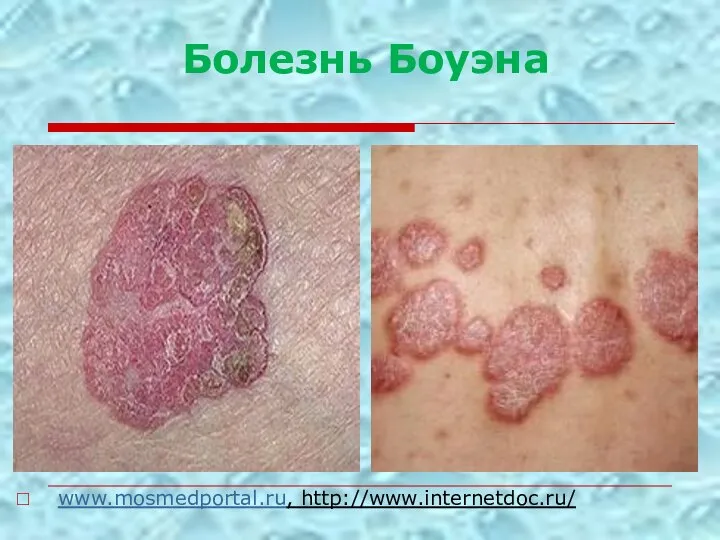 www.mosmedportal.ru, http://www.internetdoc.ru/ Болезнь Боуэна