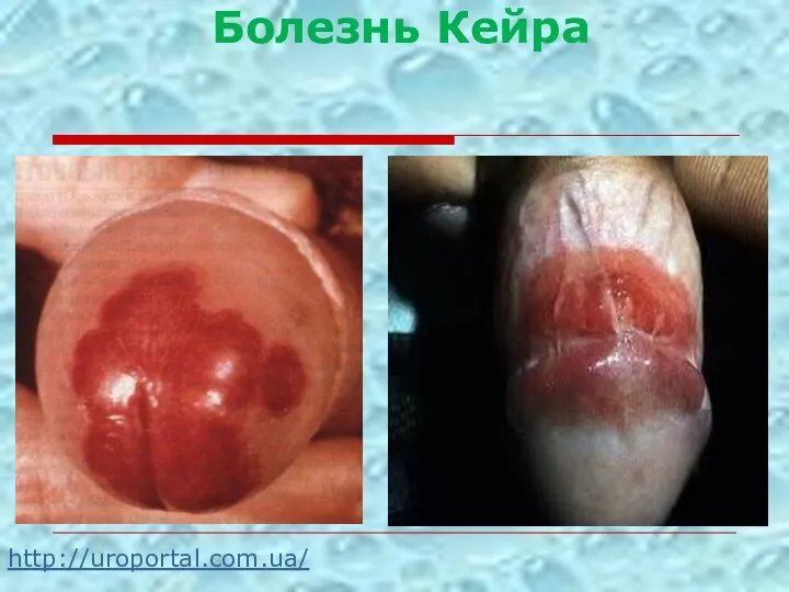 http://uroportal.com.ua/ Болезнь Кейра