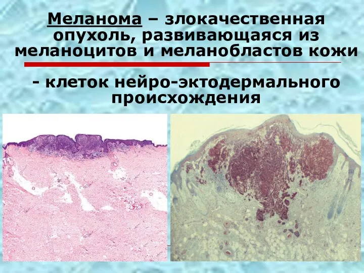 Меланома – злокачественная опухоль, развивающаяся из меланоцитов и меланобластов кожи - клеток нейро-эктодермального происхождения