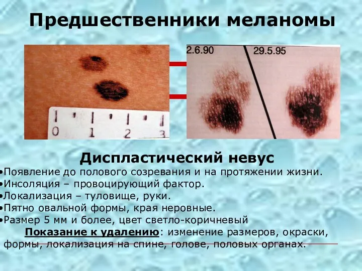 Предшественники меланомы Диспластический невус Появление до полового созревания и на протяжении жизни.