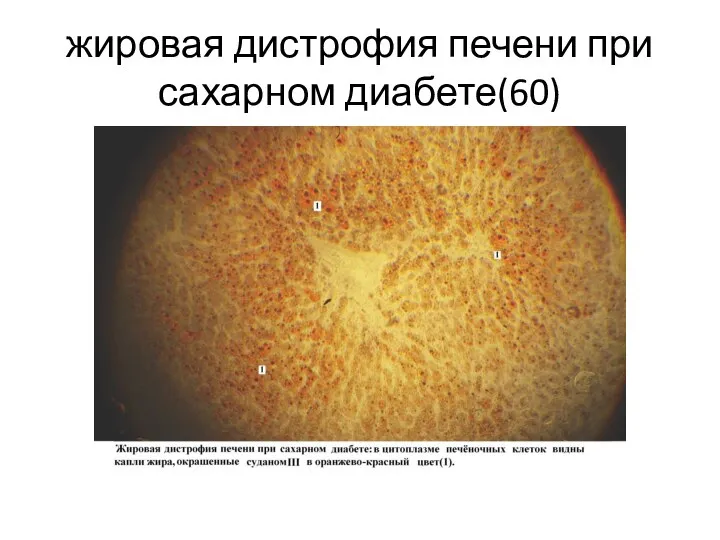 жировая дистрофия печени при сахарном диабете(60)