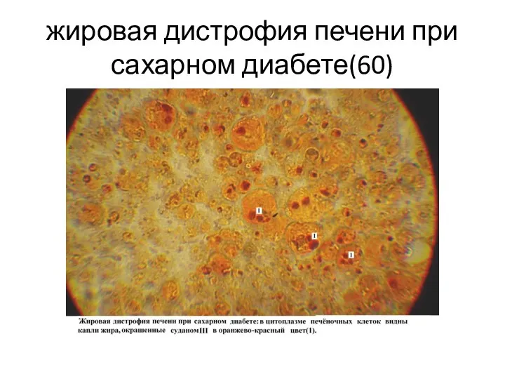 жировая дистрофия печени при сахарном диабете(60)