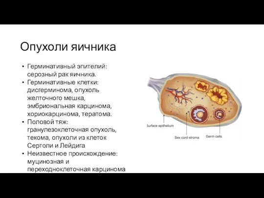 Опухоли яичника Герминативный эпителий: серозный рак яичника. Герминативные клетки: дисгерминома, опухоль желточного