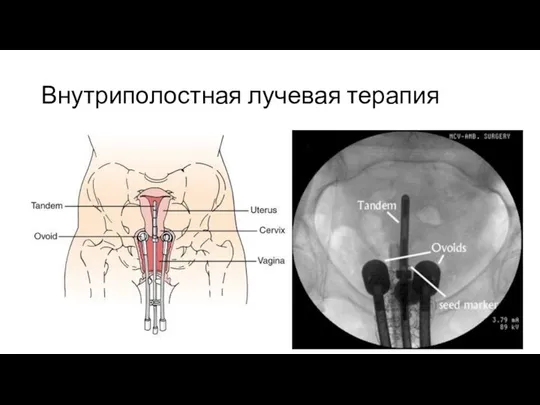 Внутриполостная лучевая терапия