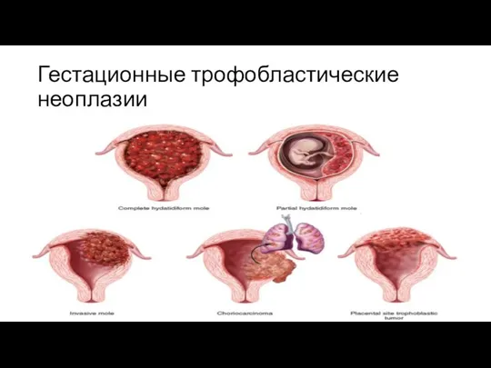 Гестационные трофобластические неоплазии