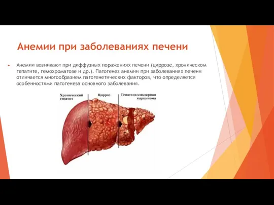 Анемии при заболеваниях печени Анемии возникают при диффузных поражениях печени (циррозе, хроническом