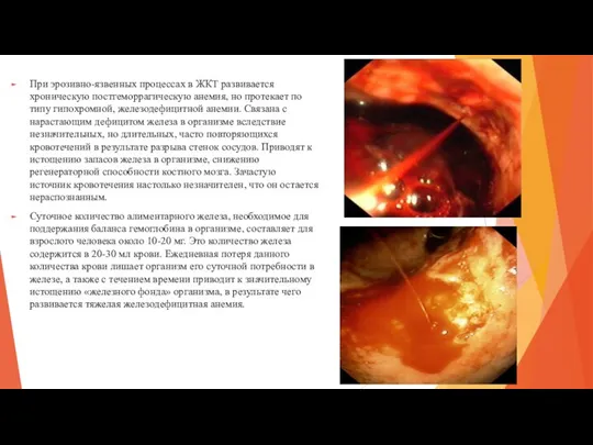 При эрозивно-язвенных процессах в ЖКТ развивается хроническую постгеморрагическую анемия, но протекает по