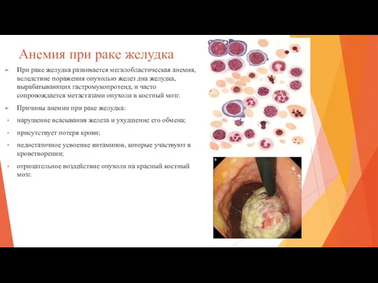 Анемия при раке желудка При раке желудка развивается мегалобластическая анемия, вследствие поражения