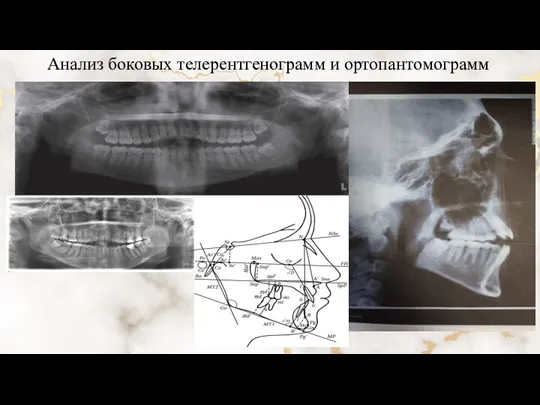 Анализ боковых телерентгенограмм и ортопантомограмм