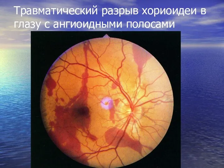 Травматический разрыв хориоидеи в глазу с ангиоидными полосами