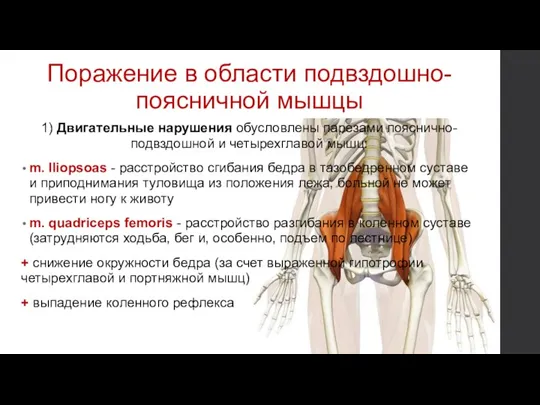 Поражение в области подвздошно-поясничной мышцы 1) Двигательные нарушения обусловлены парезами пояснично-подвздошной и