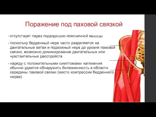 Поражение под паховой связкой отсутствует парез подвздошно-поясничной мышцы поскольку бедренный нерв часто