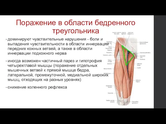 Поражение в области бедренного треугольника доминируют чувствительные нарушения - боли и выпадения