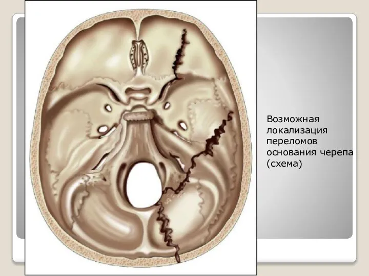 Возможная локализация переломов основания черепа (схема)