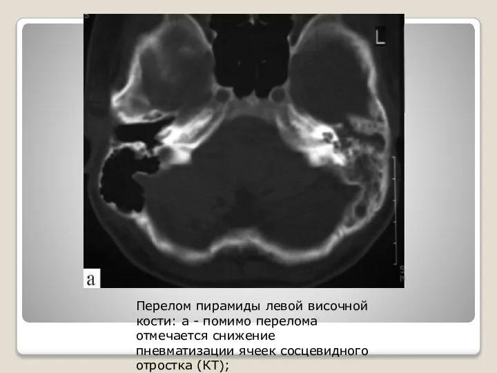 Перелом пирамиды левой височной кости: а - помимо перелома отмечается снижение пневматизации ячеек сосцевидного отростка (КТ);