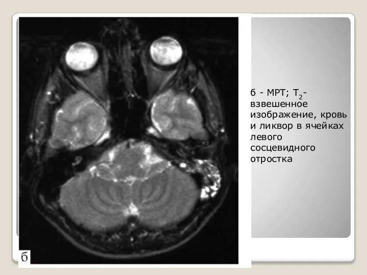 б - МРТ; Т2-взвешенное изображение, кровь и ликвор в ячейках левого сосцевидного отростка