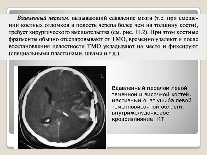 Вдавленный перелом левой теменной и височной костей, массивный очаг ушиба левой теменновисочной области, внутрижелудочковое кровоизлияние: КТ