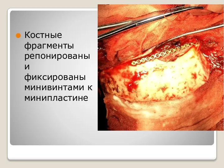 Костные фрагменты репонированы и фиксированы минивинтами к минипластине