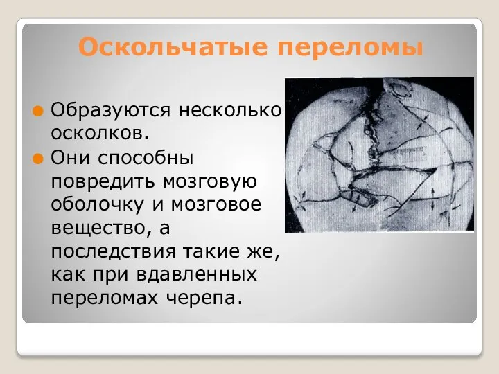 Оскольчатые переломы Образуются несколько осколков. Они способны повредить мозговую оболочку и мозговое