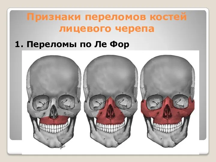 Признаки переломов костей лицевого черепа 1. Переломы по Ле Фор