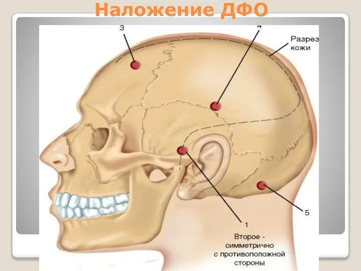 Наложение ДФО