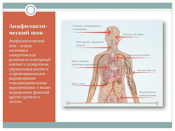 Анафилакти-ческий шок Анафилактический шок - острая системная аллергическая реакция на повторный контакт