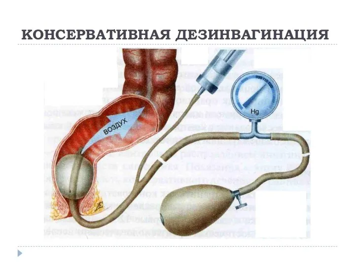 КОНСЕРВАТИВНАЯ ДЕЗИНВАГИНАЦИЯ