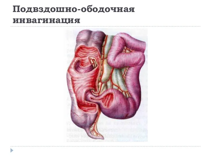 Подвздошно-ободочная инвагинация