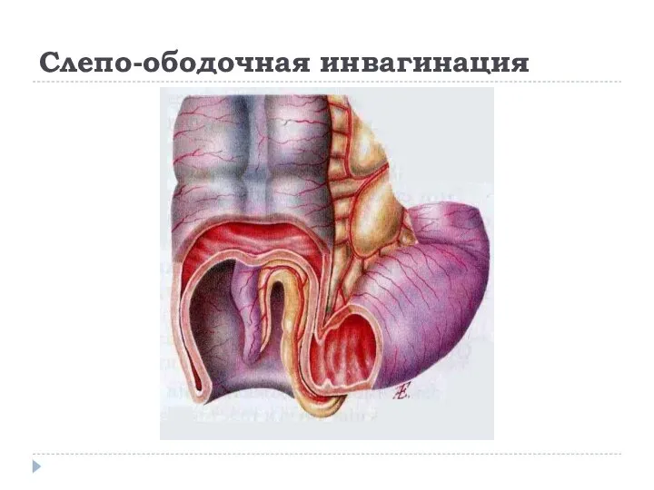 Слепо-ободочная инвагинация