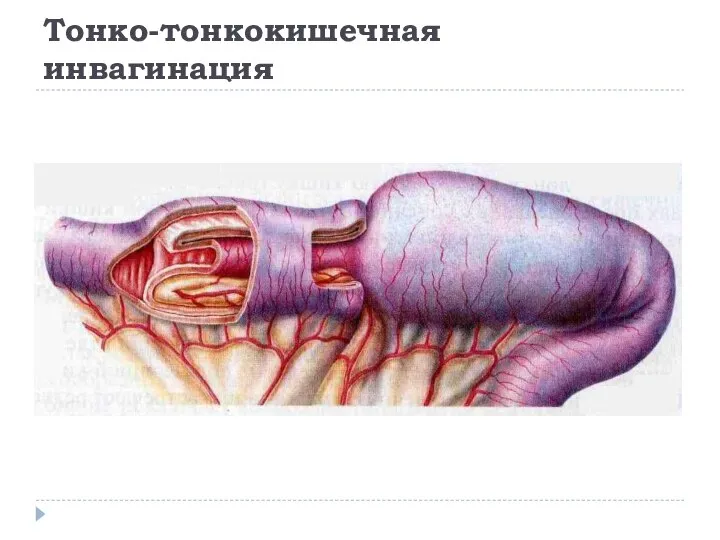 Тонко-тонкокишечная инвагинация