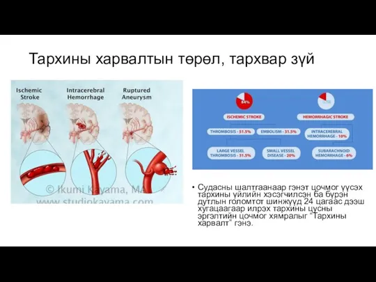 Тархины харвалтын төрөл, тархвар зүй Судасны шалтгаанаар гэнэт цочмог үүсэх тархины үйлийн